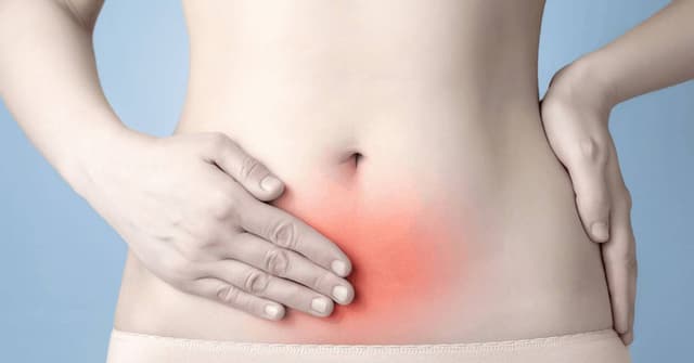 Çikolata Kistleri (Endometriozis) image