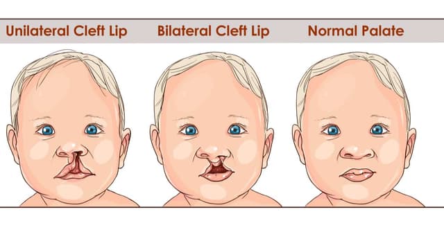 Bebeklerde Yarık Damak Nedir? Belirtileri Nelerdir? image
