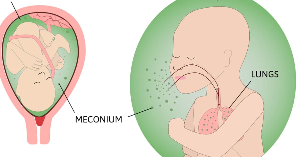 mekonyum-aspirasyonu-sendromu