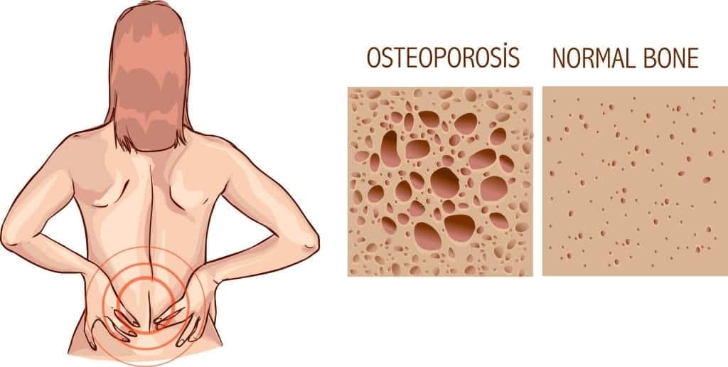 Osteoporoz