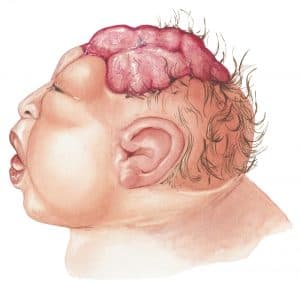 What is a Neural Tube Defect? How Is It Treated? (2023 Updated) 3 neural tube defect and its treatment