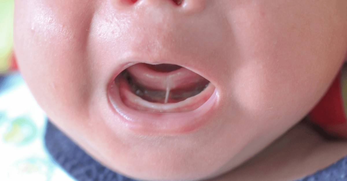 Bebeklerde Dil Bağı Belirtileri Nelerdir?