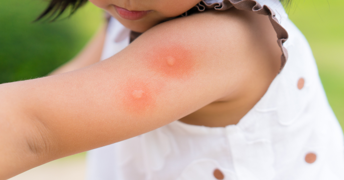 bebeklerde sivrisinek isirigi ne iyi gelir nasil gecer