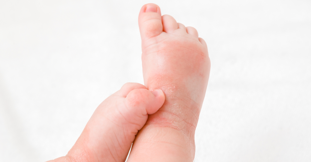 How to Recognize Allergy Symptoms in Babies? 2 baby-allergy-symptoms-how-to-understand